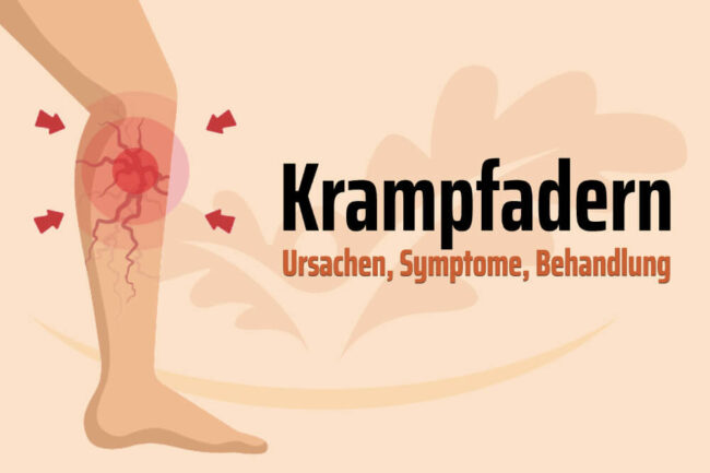 Krampfadern Ursachen Risikofaktoren Behandlung